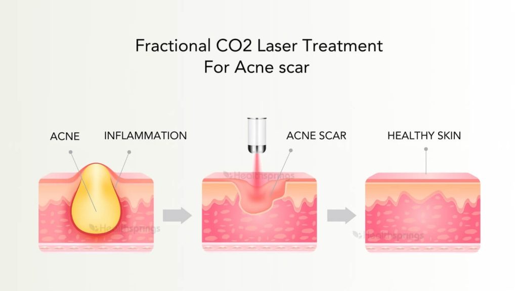 Benefits of Fractional CO2 Laser Treatment For Acne Scar