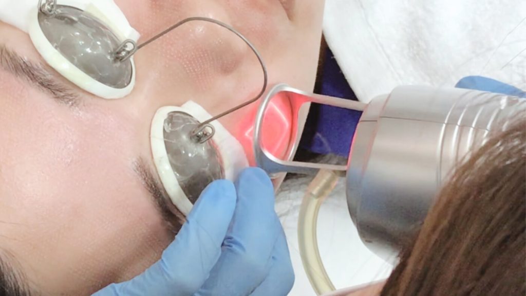 Fractional CO2 Laser