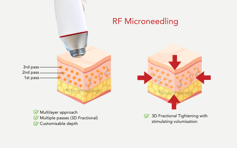 RF Microneedling 1