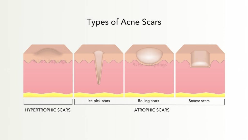 Types of Acne Scars