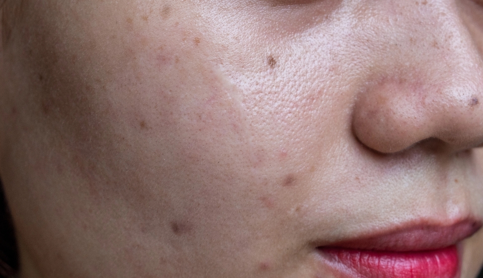 black spots scars acne face asian young woman