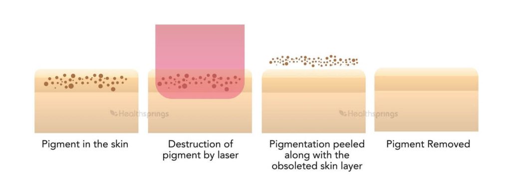 How Does Pico Laser work