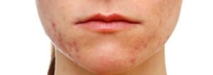 Post-Inflammatory Hyperpigmentation (PIH)