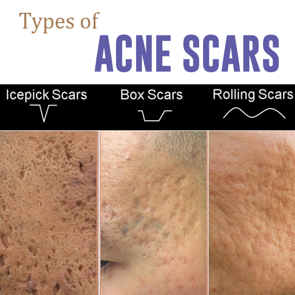 SCAR SQUARE