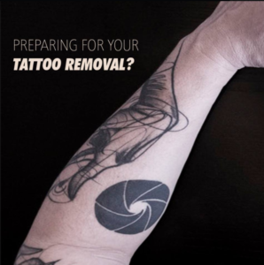 Tattoo Removal