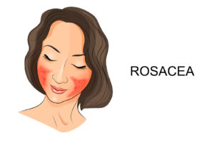 Symptoms & Triggers of Rosacea