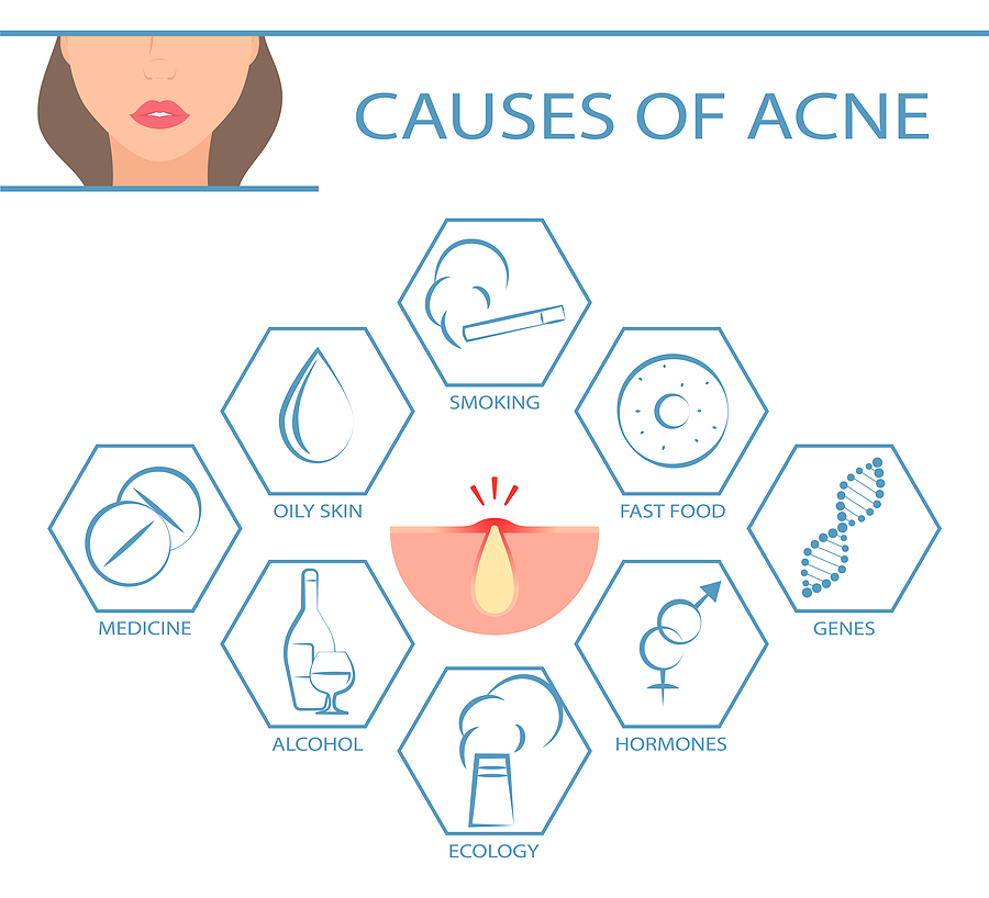 What Food Causes Acne? Healthsprings