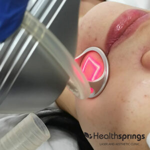 CO2 Laser vs INFINI for Acne Scars