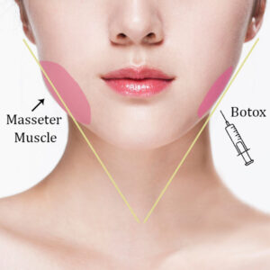 Botox Jaw Reduction