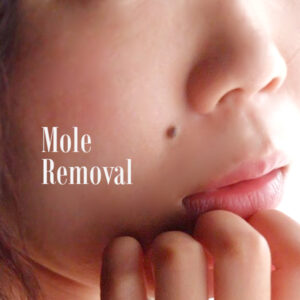 Laser Mole Removal