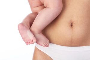 What is Diastasis Recti aka
