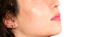 How to treat PIH (acne marks) and scars