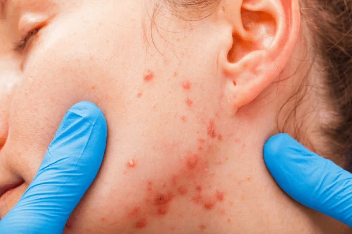 woman has her acne scars checked by the aesthetic doctor