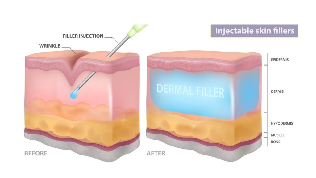 What is Eye Filler