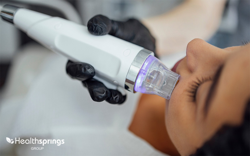 RF Microneedling Treatment