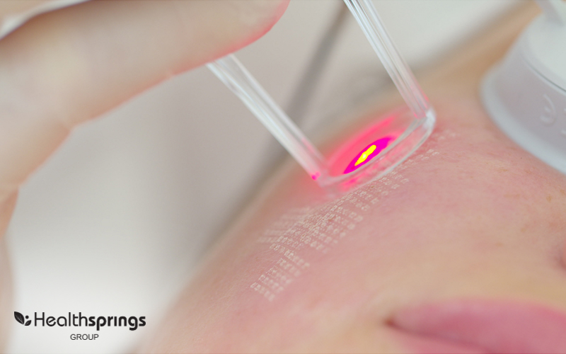 Image of lasers in a laser treatment