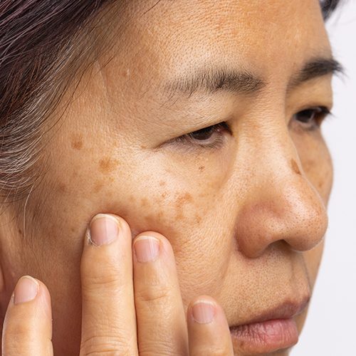 Image of person with Melasma