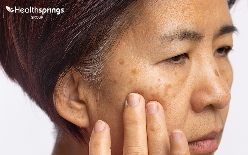Image of person with Melasma