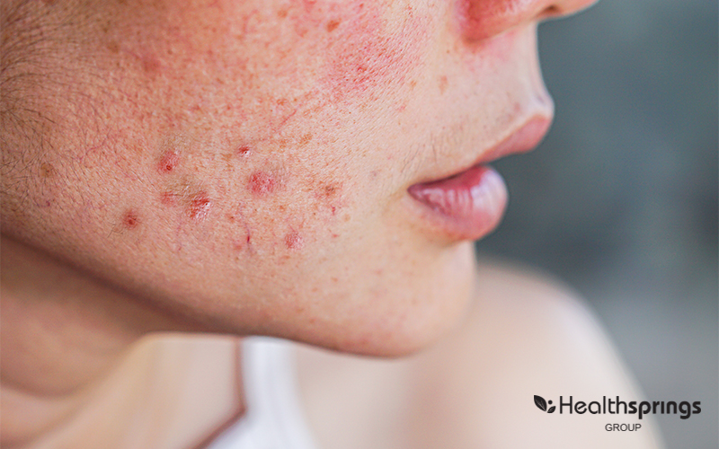 A Persons Skin with Acne Scars