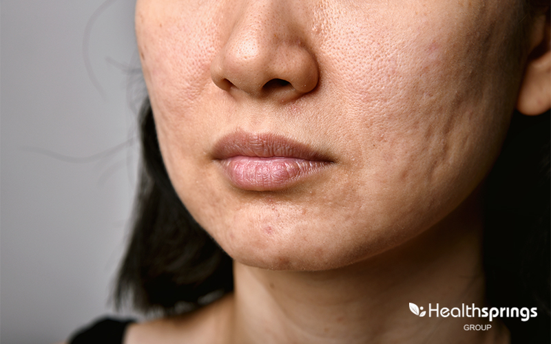 A Women Skin With Acne Scars
