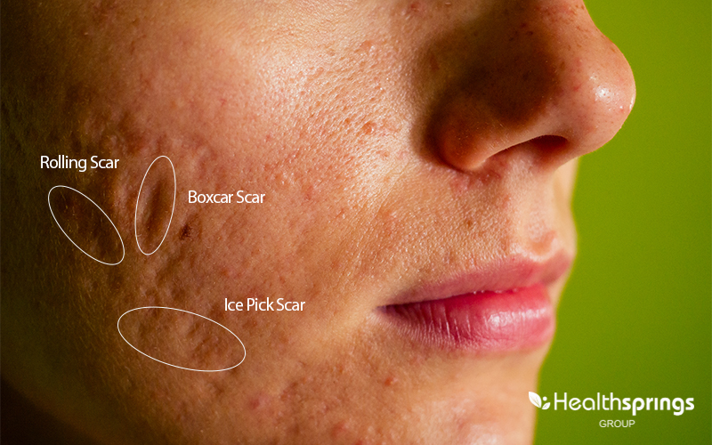 Atrophic Acne Scars