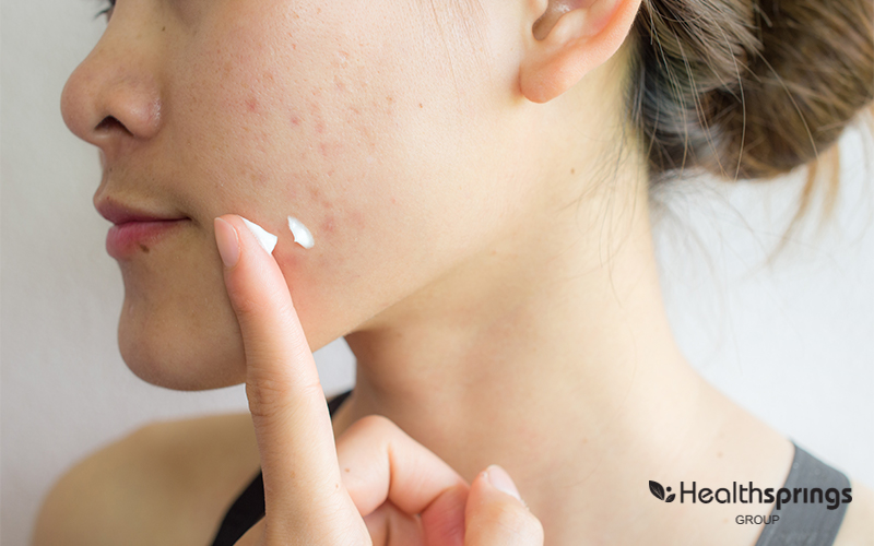 Person Applying A Cream on Acne