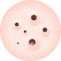 BLACKHEADS AND WHITEHEADS