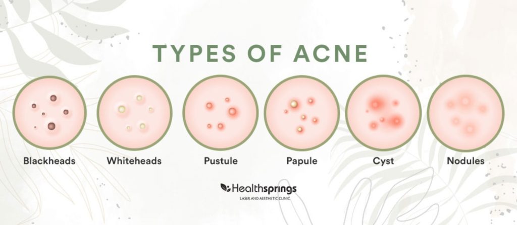 Types of Acne