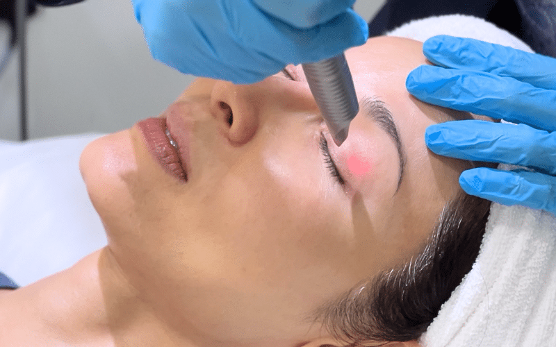 fotona eye light peel