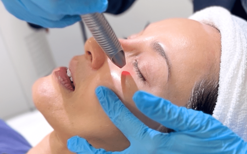 fotona eye smooth laser