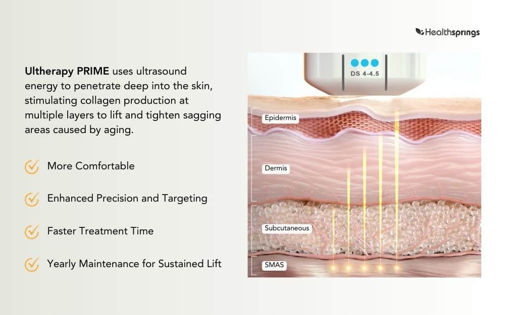 ultherapy prime sg how does ultherapy prime work?