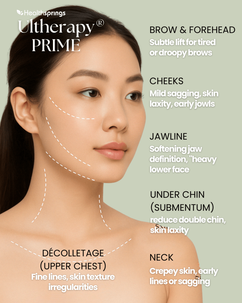 Ultherapy treatment zones