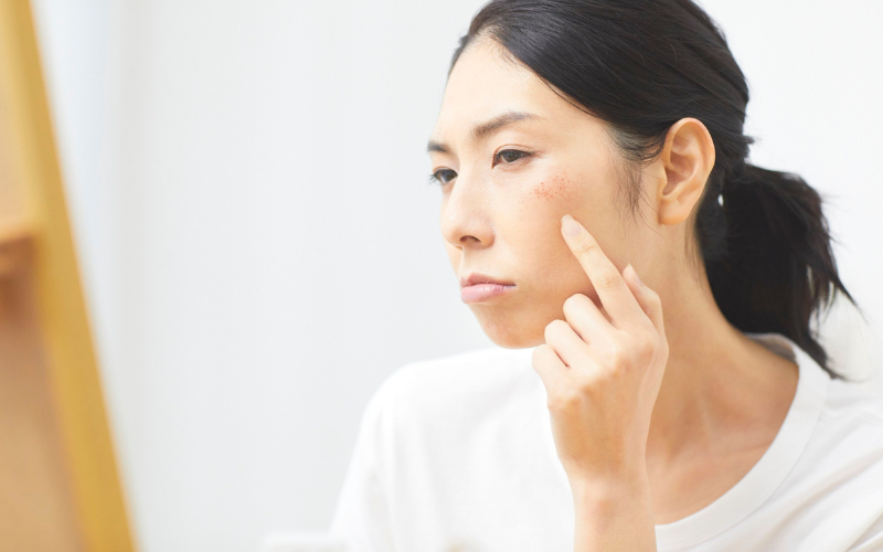 freckles or sunspots treatment