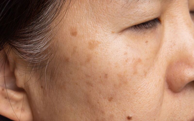 melasma laser sg