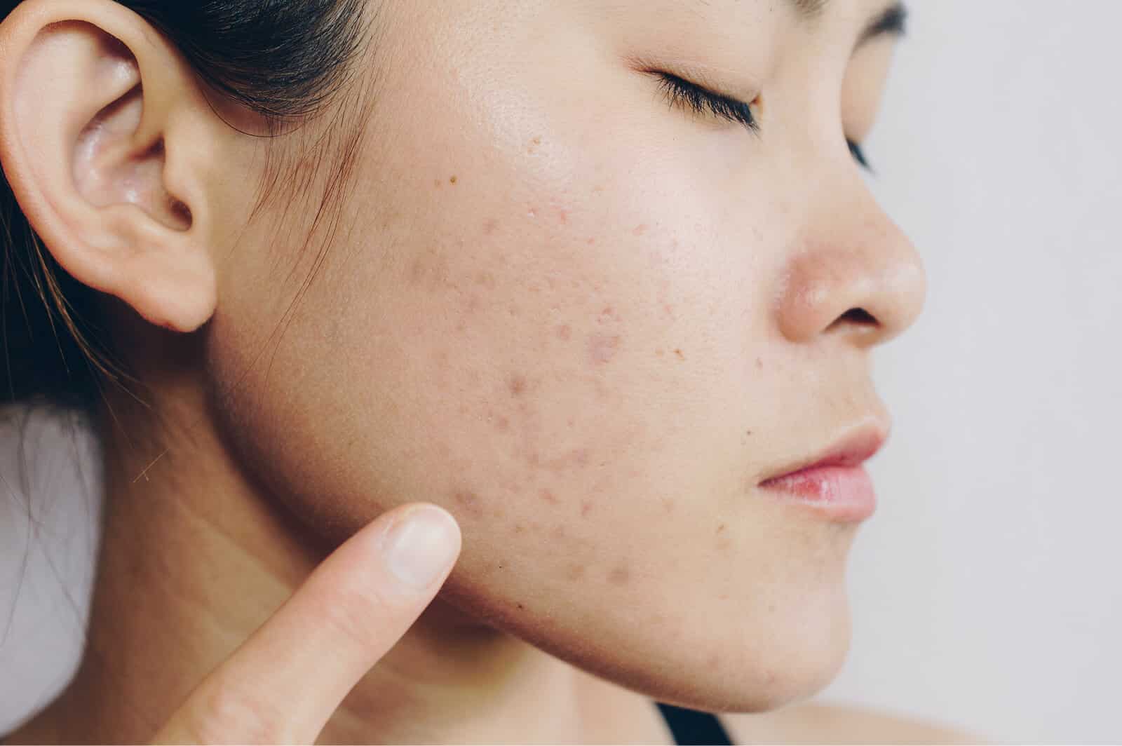 Acne scar treatment Singapore